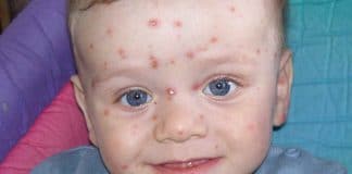 varicela en los niños