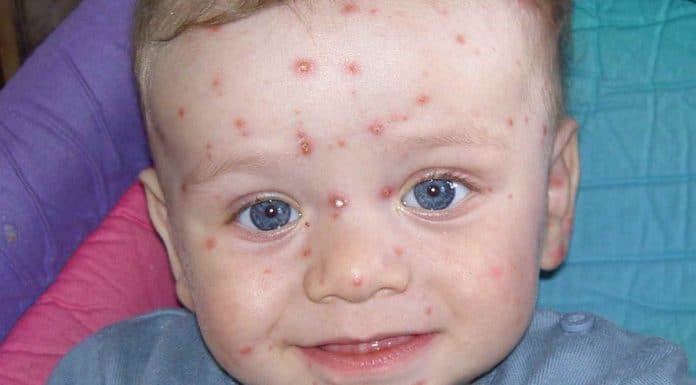varicela en los niños