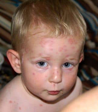 Primeros síntomas de la varicela en niños