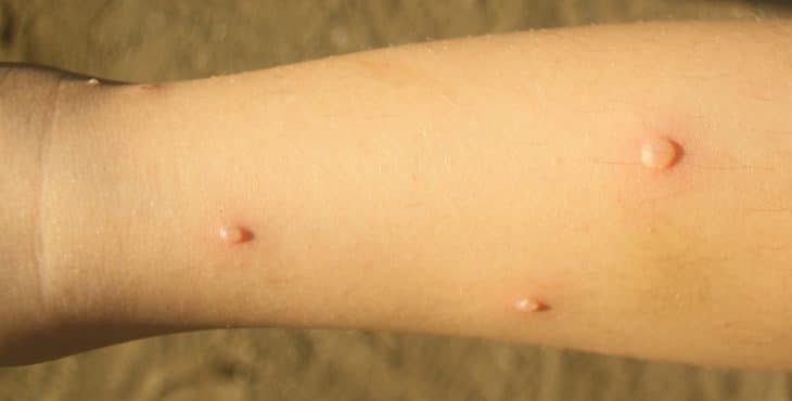 Síntomas de varicela en los niños