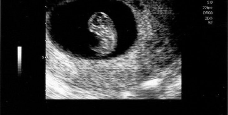 Imagen sonográfica de un embrión de 8 semanas