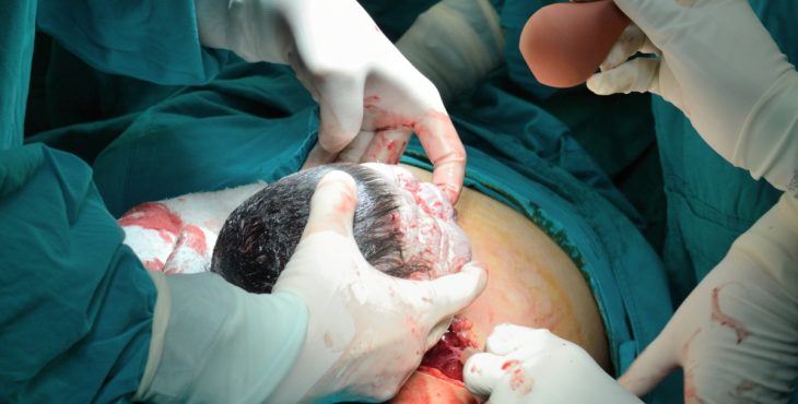 operacion cesarea