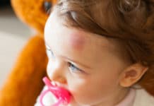 Golpes en la cabeza de niños