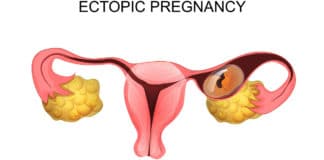 Implantación fuera del útero
