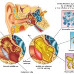 Acumulación de pus en el oído medio