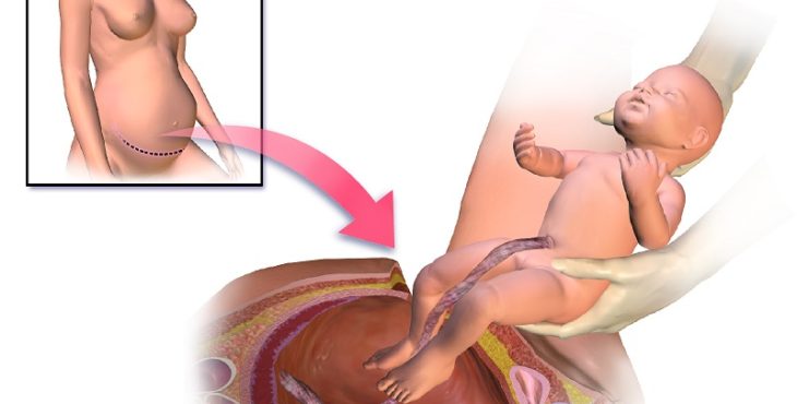 La cesárea puede estar indicada cuando el embarazo es prolongado
