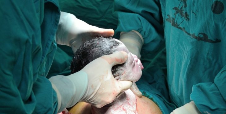 Niño nacido por cesárea