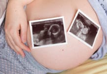 Síndrome de transfusión entre gemelos, causas