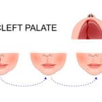 Complicaciones del labio leporino