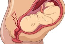 Los dedos se introducen en el cuello uterino para desprender las membranas amnióticas