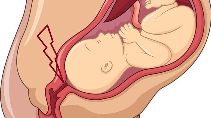 Los dedos se introducen en el cuello uterino para desprender las membranas amnióticas