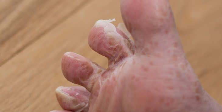 Descamación de la piel de los pies
