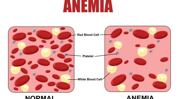 Anemia y disminución de los glóbulos rojos