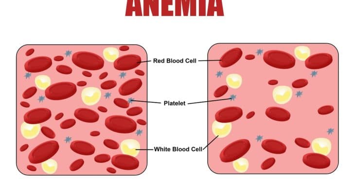 Anemia y disminución de los glóbulos rojos
