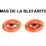 Formas blefaritis