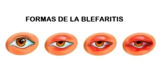 Tipos de blefaritis