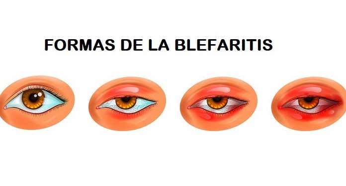 Tipos de blefaritis