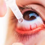 La conjuntivitis es conocida como ojos rojos