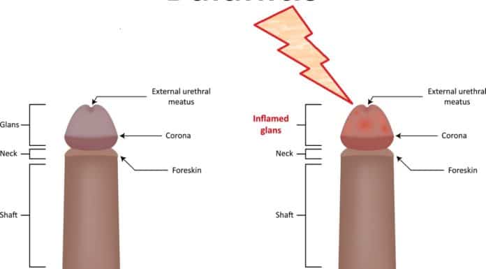 Balanitis