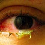 Conjuntivitis bacteriana