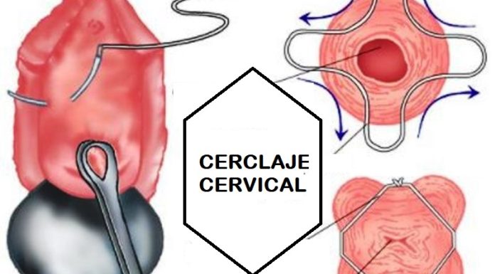 Uno de los métodos de cerclaje quirúrgico