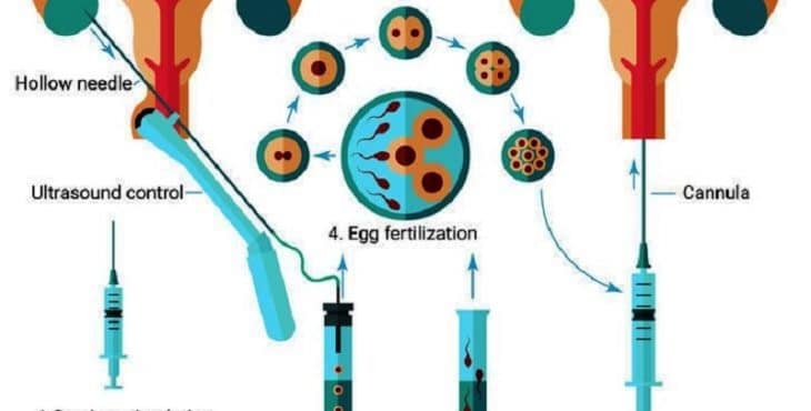 La fertilización in vitro