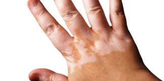 Lesión típica de vitiligo