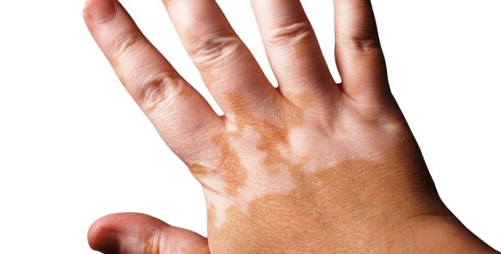 Lesión típica de vitiligo