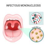 mononucleosis virus