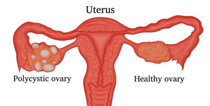 Síndrome de ovarios poliquísticos