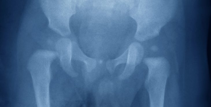 Rayos X de la cadera y la pelvis 