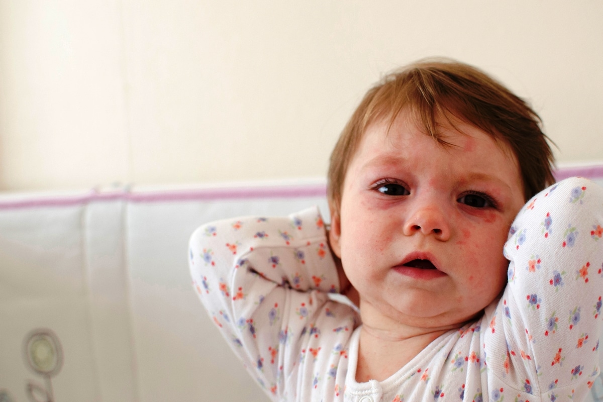 Una Enfermedad Comun En Las Guarderias La Roseola