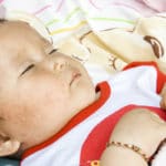 Cara de un bebé enfermo roséola infantum
