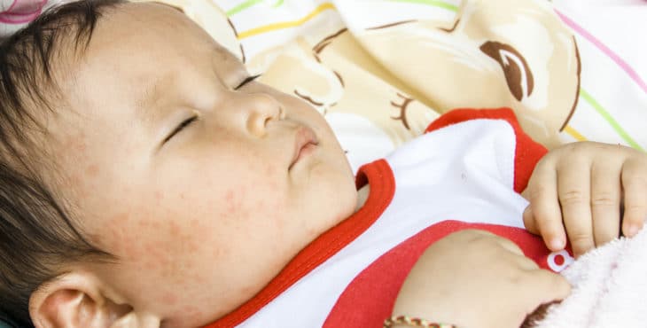 Bebé con manifestaciones cutáneas de la Sexta enfermedad