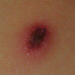 4-Lesion cutanea de la fiebre botnosa