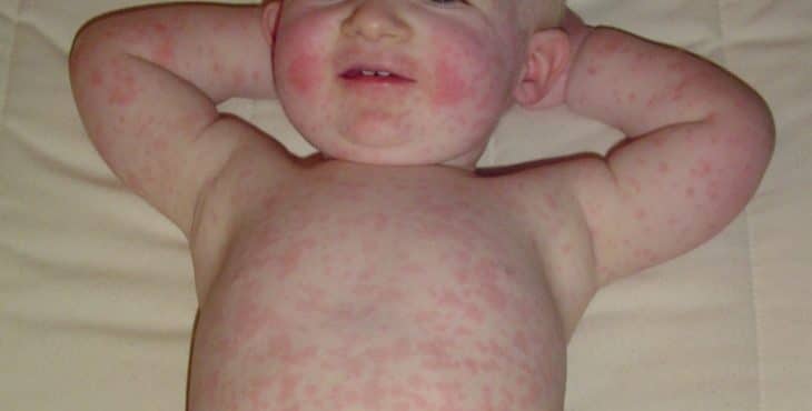 Bebé con eritema infeccioso