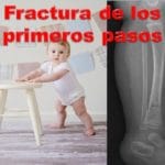 2-Fractura de los primeros pasos