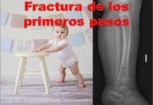 Lesión en el extremo distal de la tibia