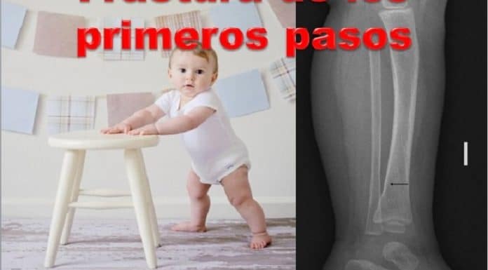 Lesión en el extremo distal de la tibia