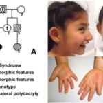 1-Sindrome de Angelman