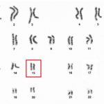 3-Alteracion en el cromosoma 15