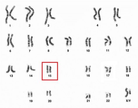 Alteración cromosómica en el Síndrome de Angelman