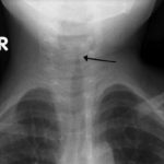 1-El crup se diagnostica clinicamente