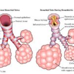 2- Bronquiolitis