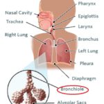 4-La bronquiolitis