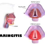 4-Laringitis