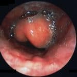 1-Imagen endoscópica de la epiglotitis