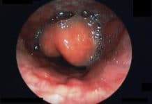 Epiglotitis