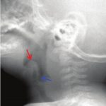 5-Epiglotitis en un bebe