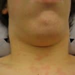 1- Entre los síntomas de la mononucleosis infecciosa está la inflamación de los ganglios